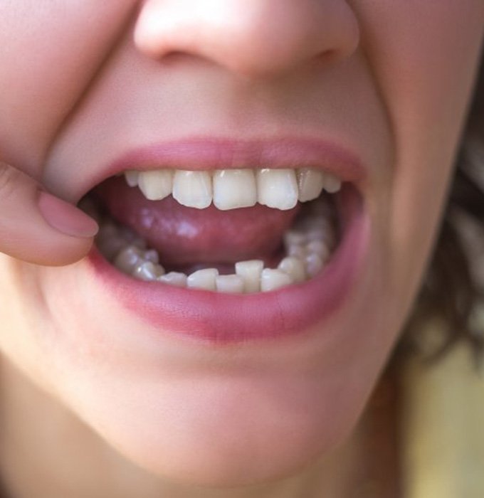 Close up of woman inserting Invisalign tray 