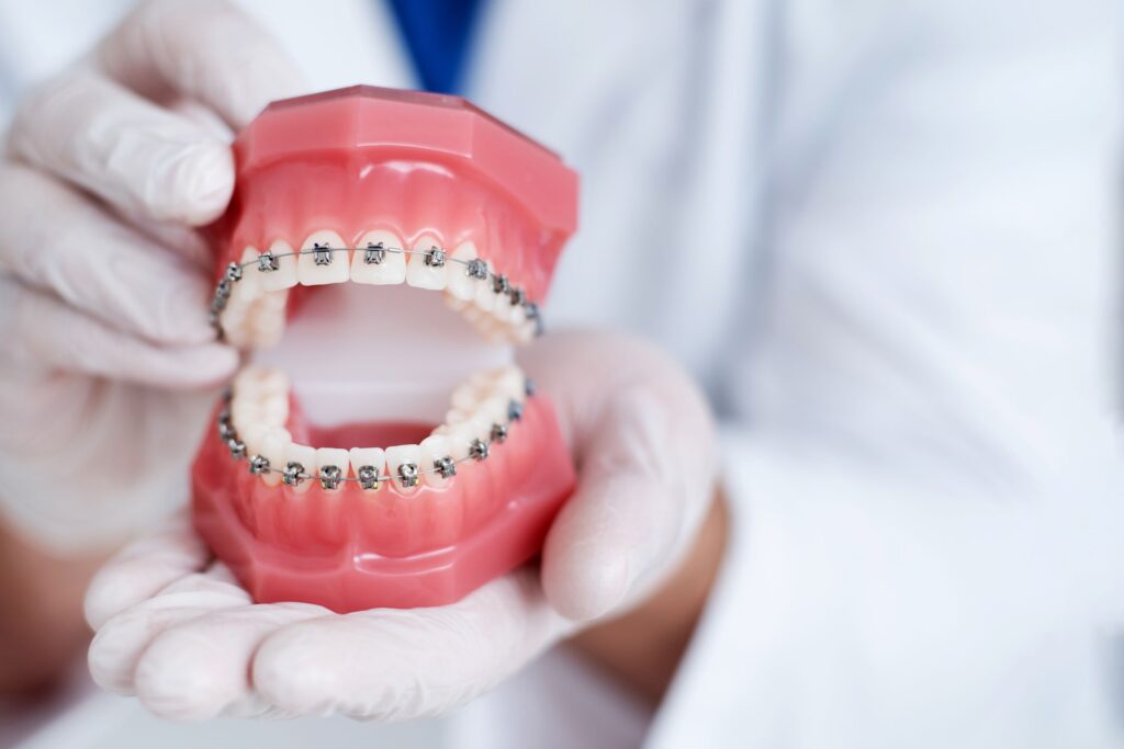 Dentist wearing white gloves holding model teeth with braces on them